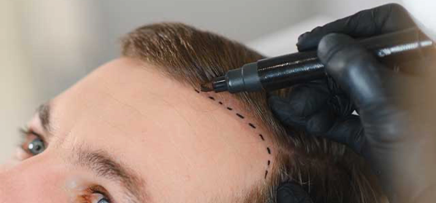 Πώς Σχεδιάζεται η Ιδανική Hairline