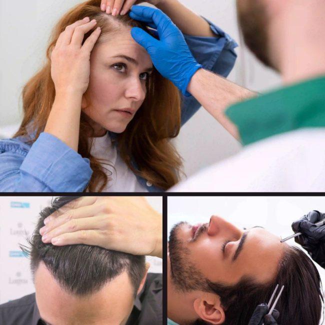 ακούρευτη fue μεταμόσχευση μαλλιών