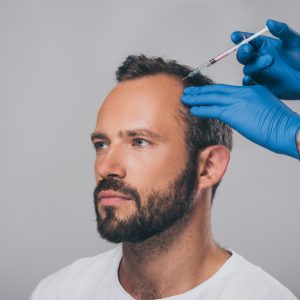 Μεσοθεραπεία κατά της Τριχόπτωσης